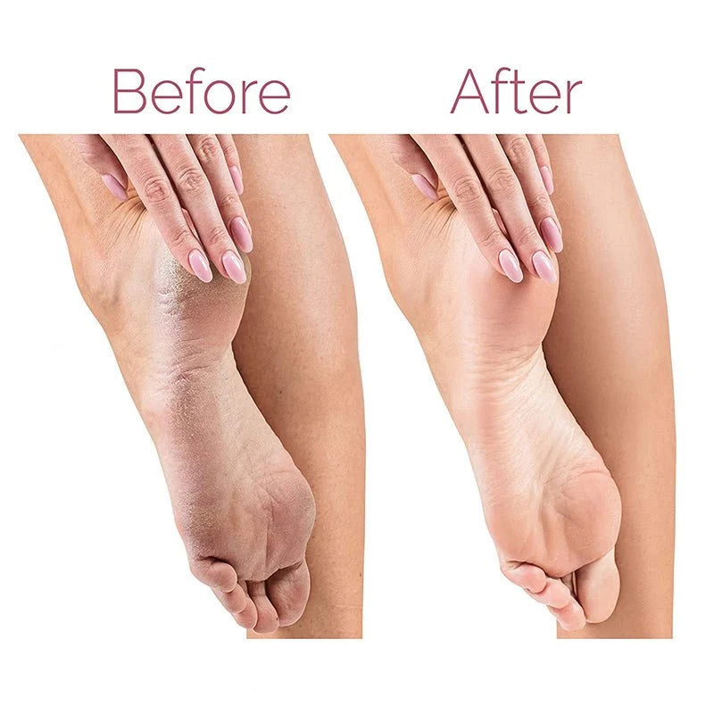 Electric Foot File Callus Remover – Smooth Feet at Home